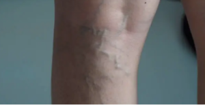 modern varicose vein treatment